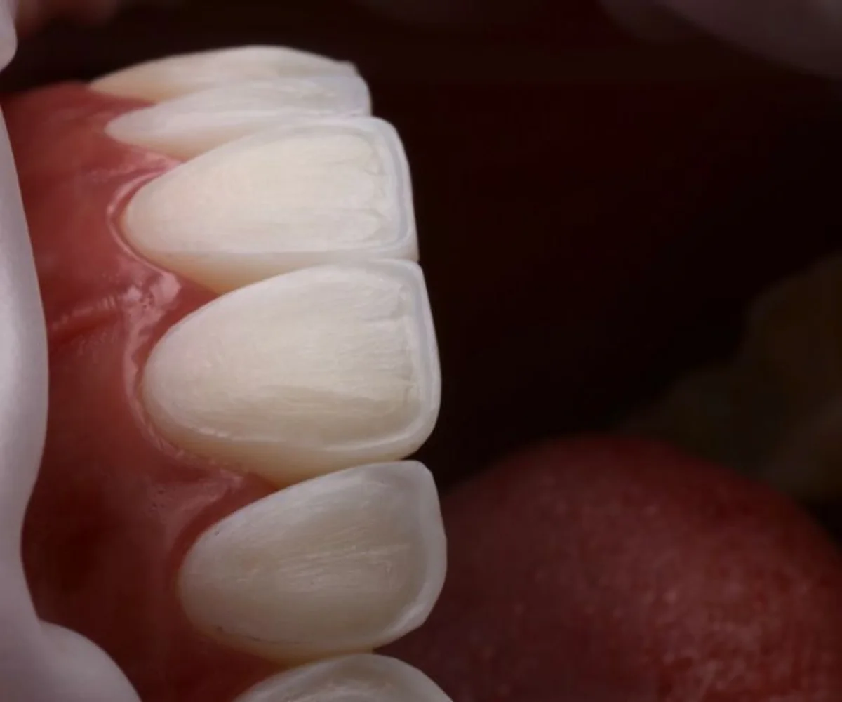 Gros plan sur des dents usées