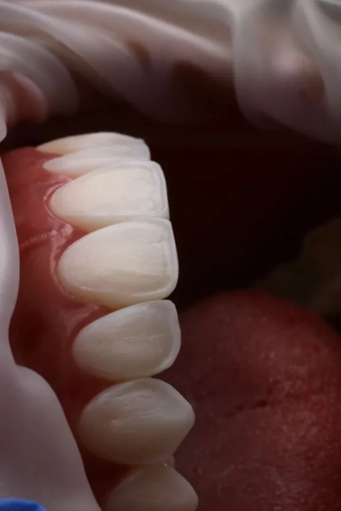 Dents naturelles